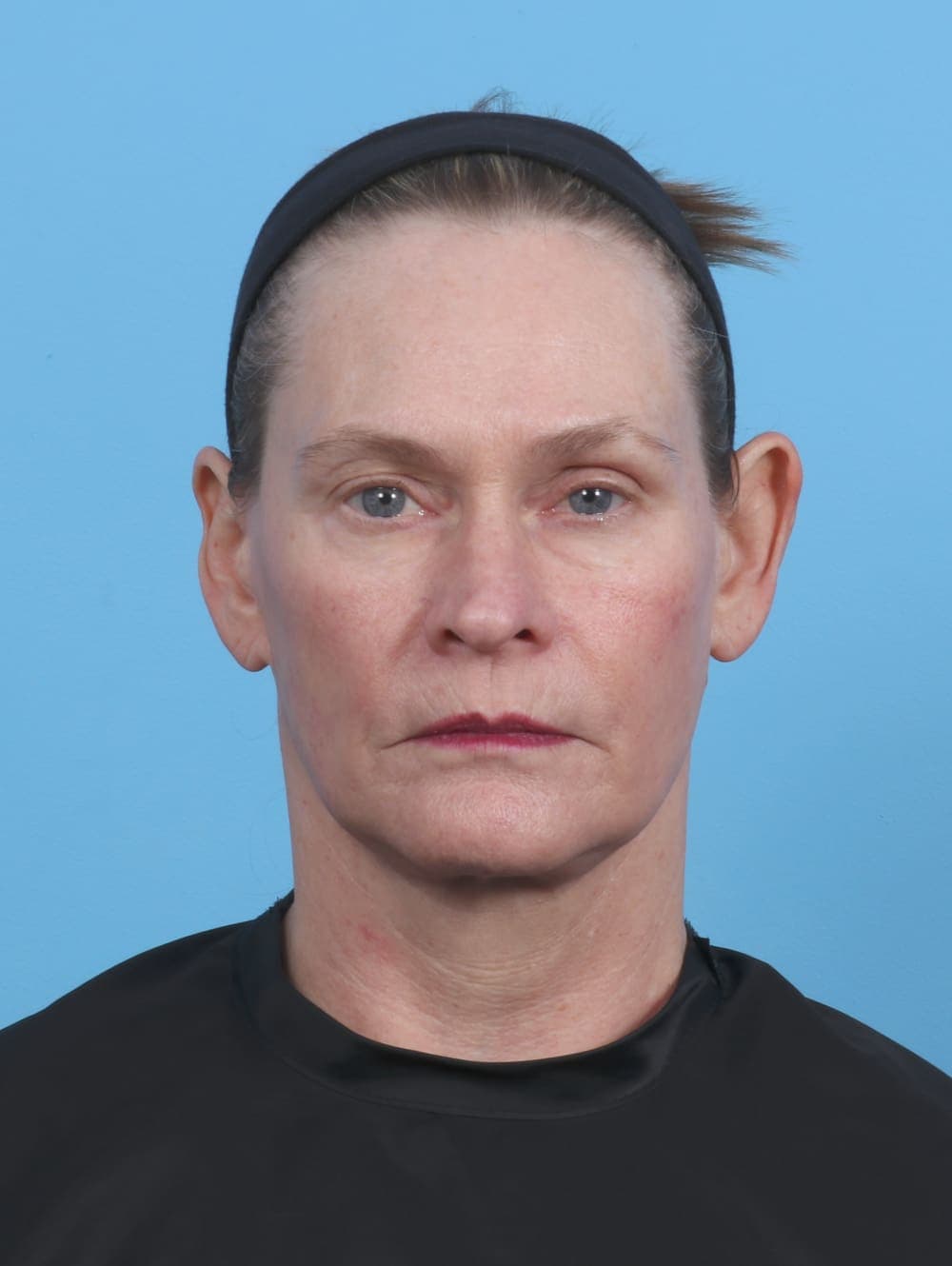 Facelift case #4379 after, image 1