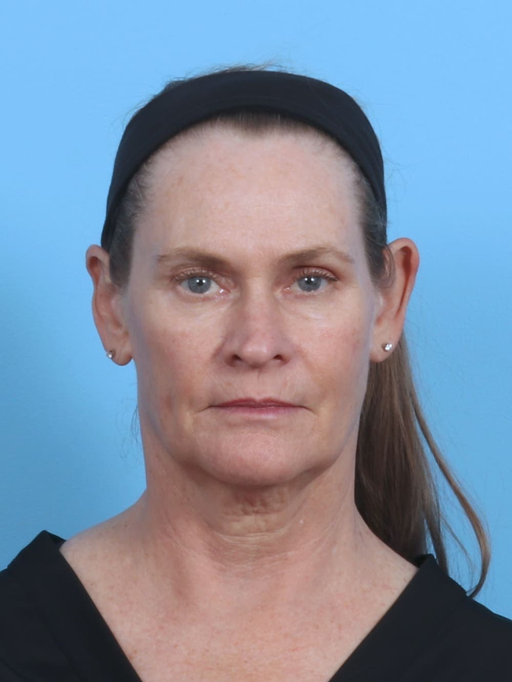 Facelift case #4379 before, image 1