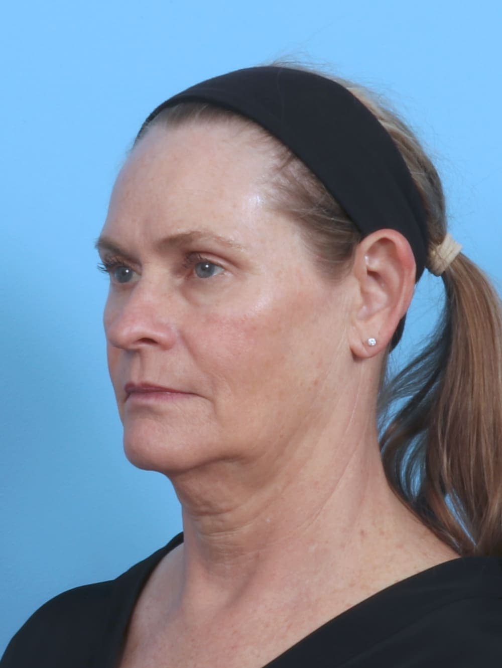 Facelift case #4379 before, image 2