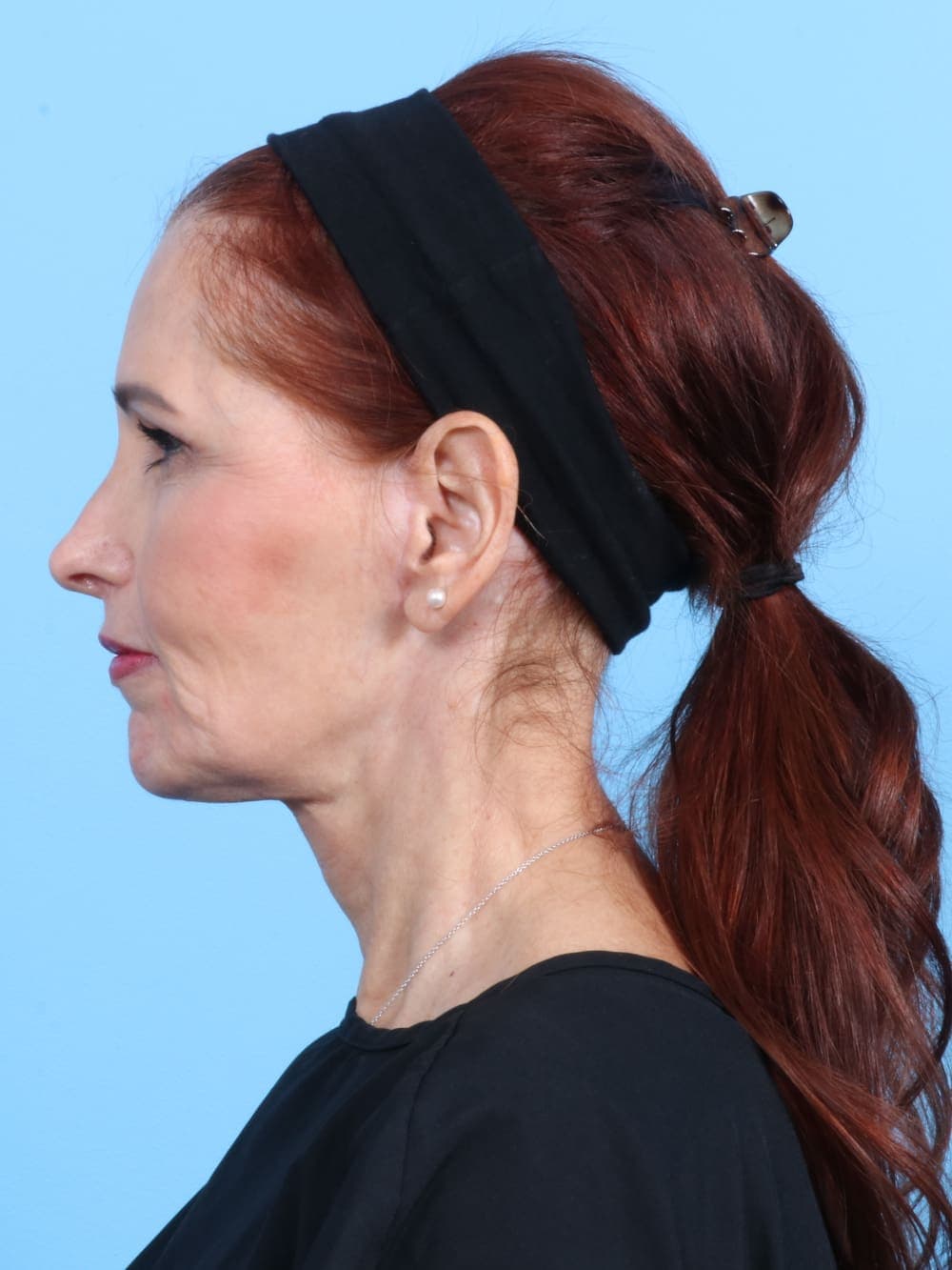Facelift case #1900 after, image 3