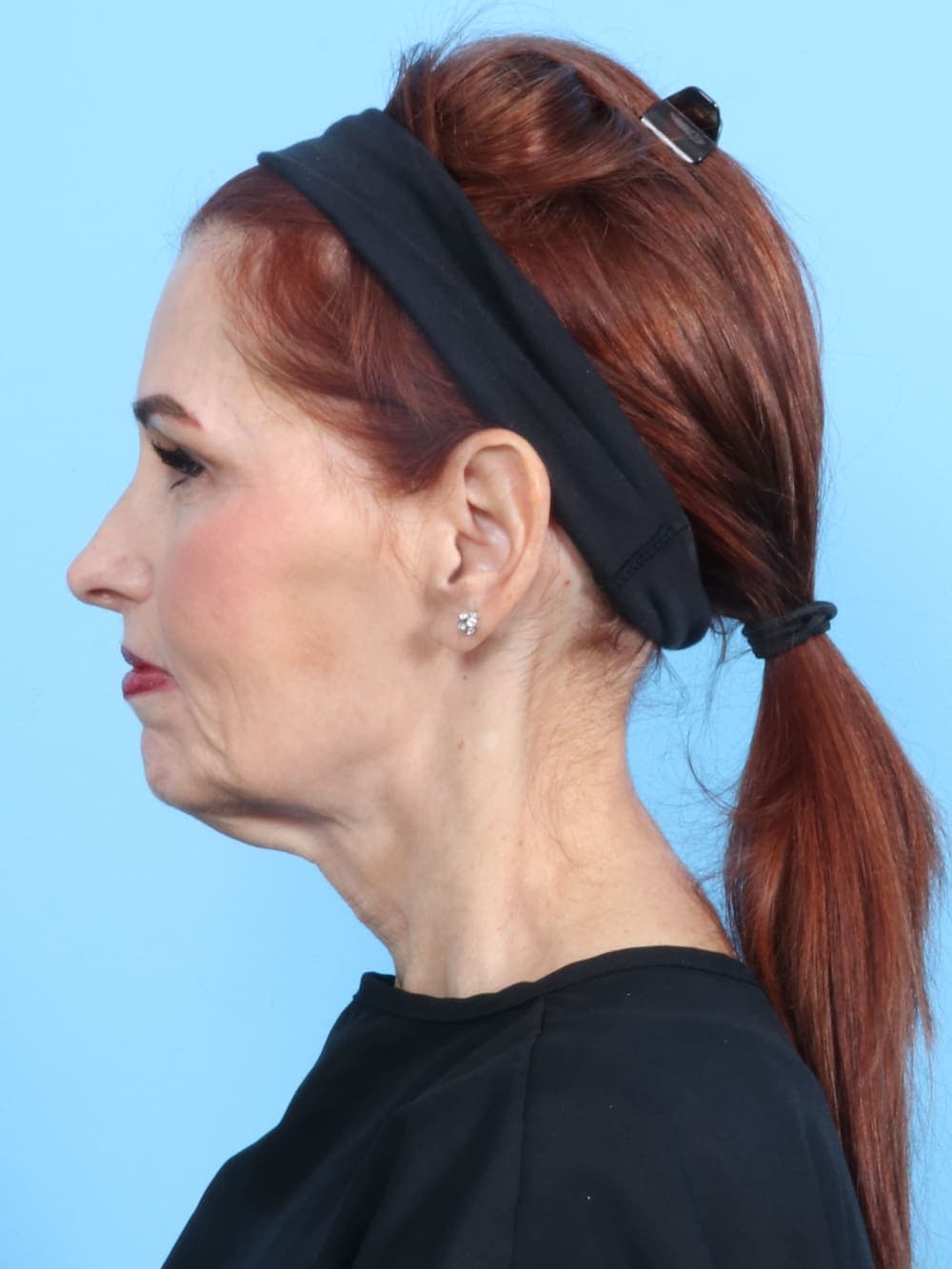 Facelift case #1900 before, image 3