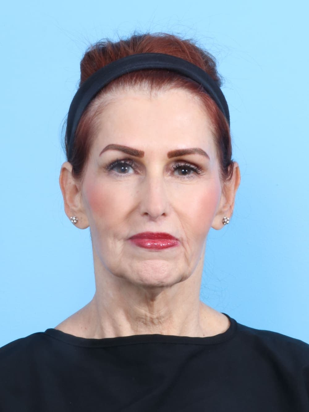Facelift case #1900 before