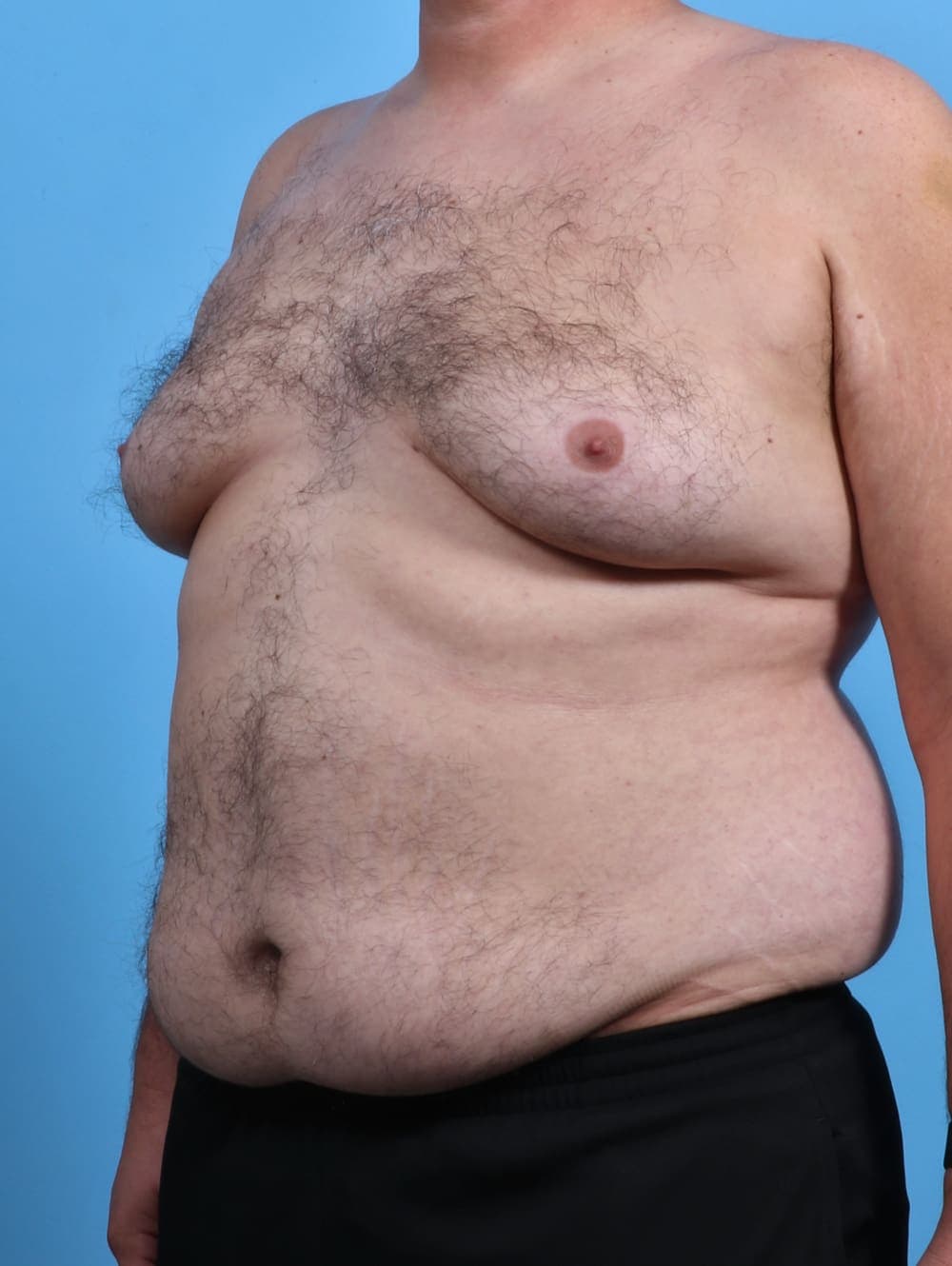Male Breast Reduction case #3795 before, image 2