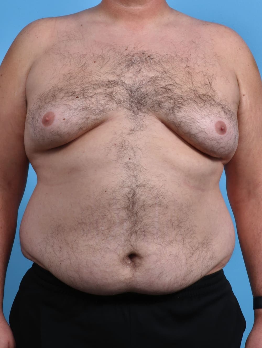Male Breast Reduction case #3795 before, image 1