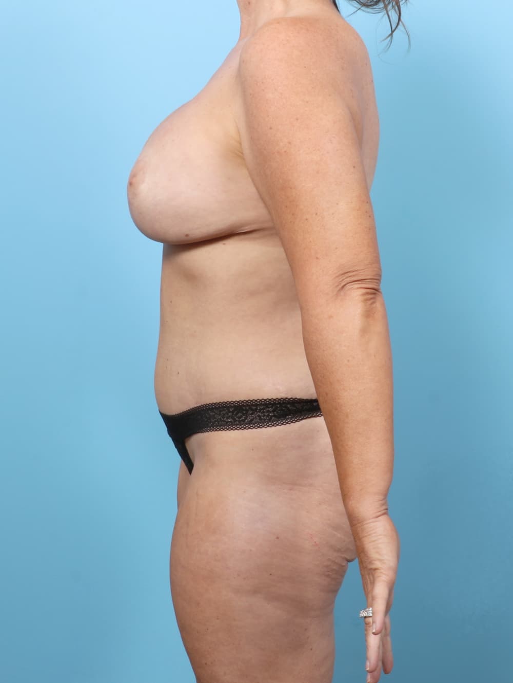 Tummy Tuck case #8203 after, image 3