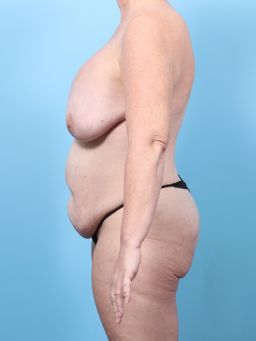 Tummy Tuck case #8203 before, image 3
