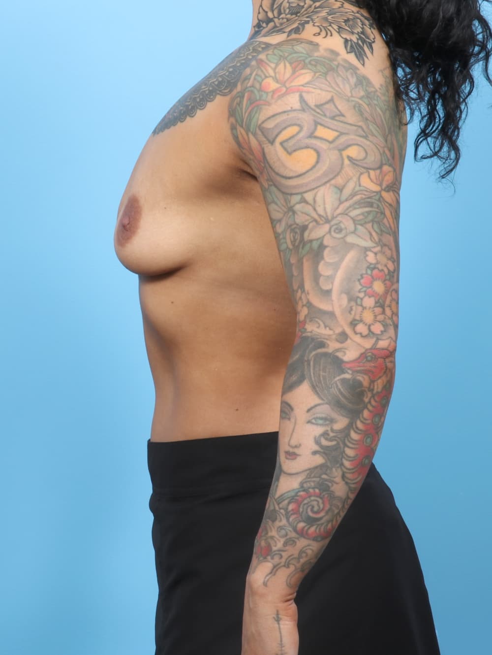 Breast Augmentation case #8439 before, image 3