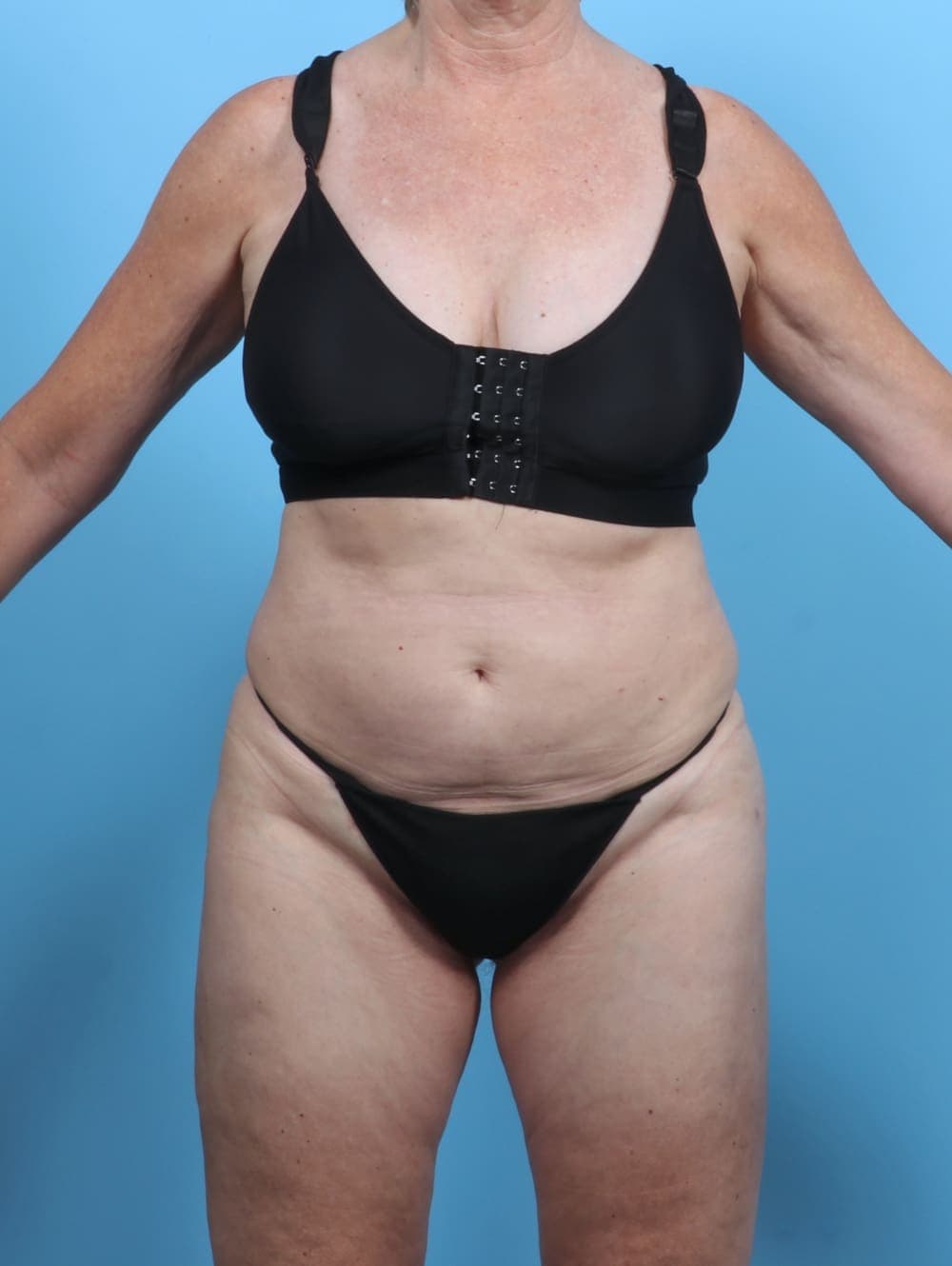 Liposuction case #5634 after