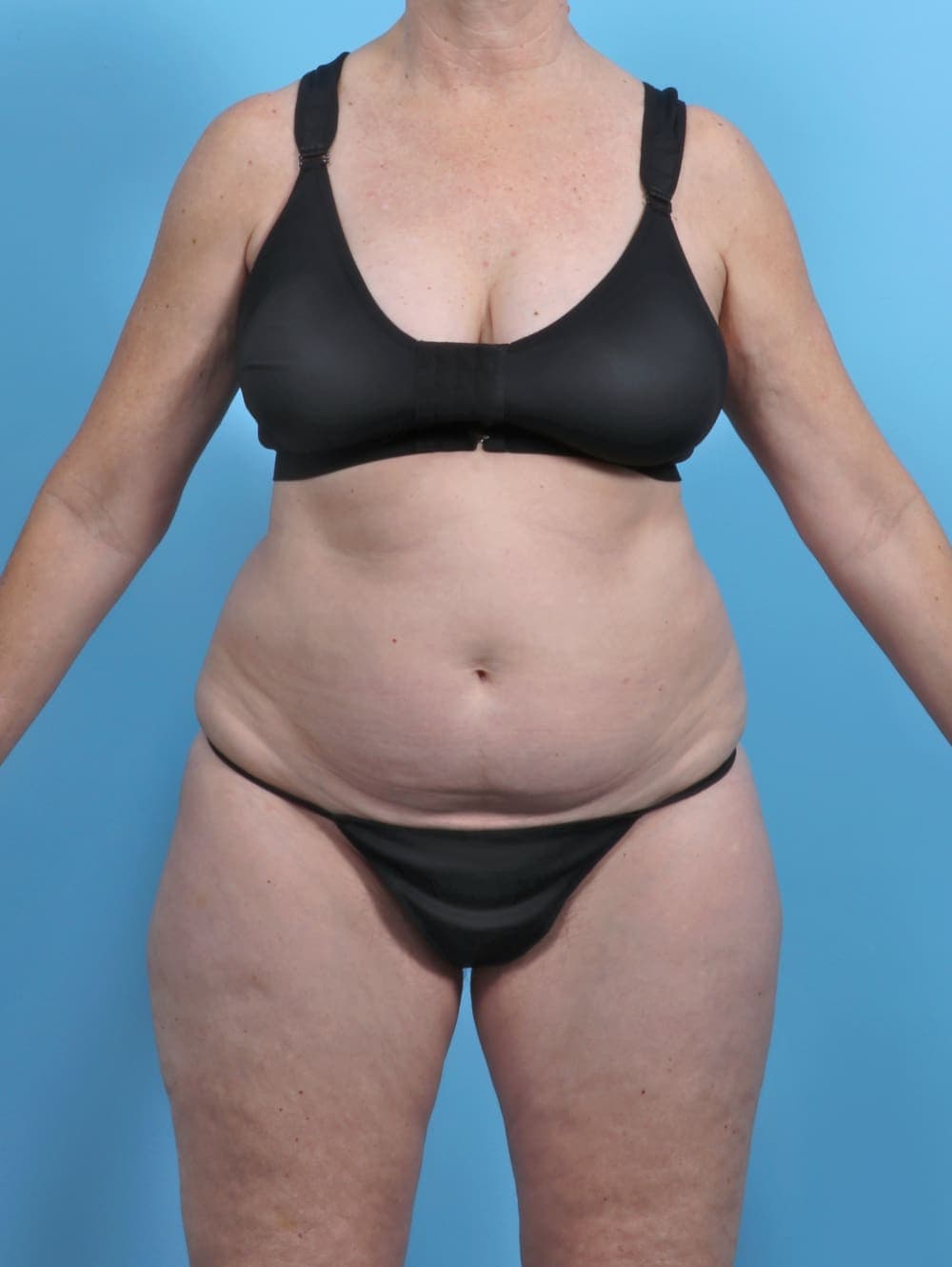 Liposuction case #5634 before