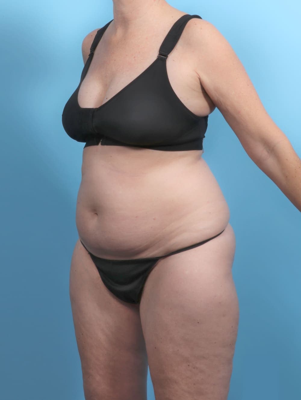 Liposuction case #5634 before, image 3