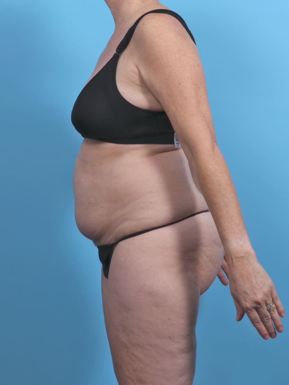 Liposuction case #5634 before, image 4