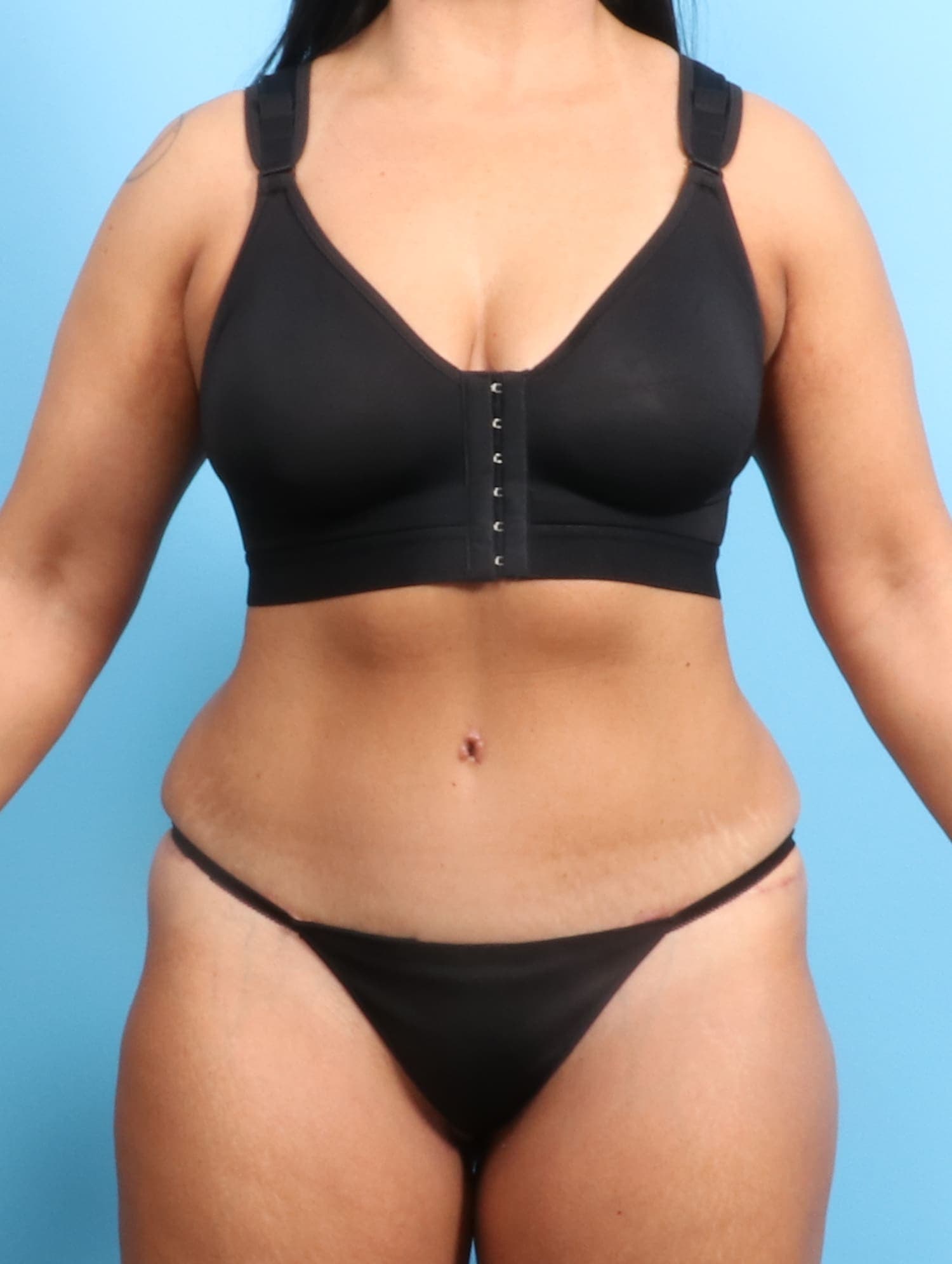 Tummy Tuck case #1526 after, image 1