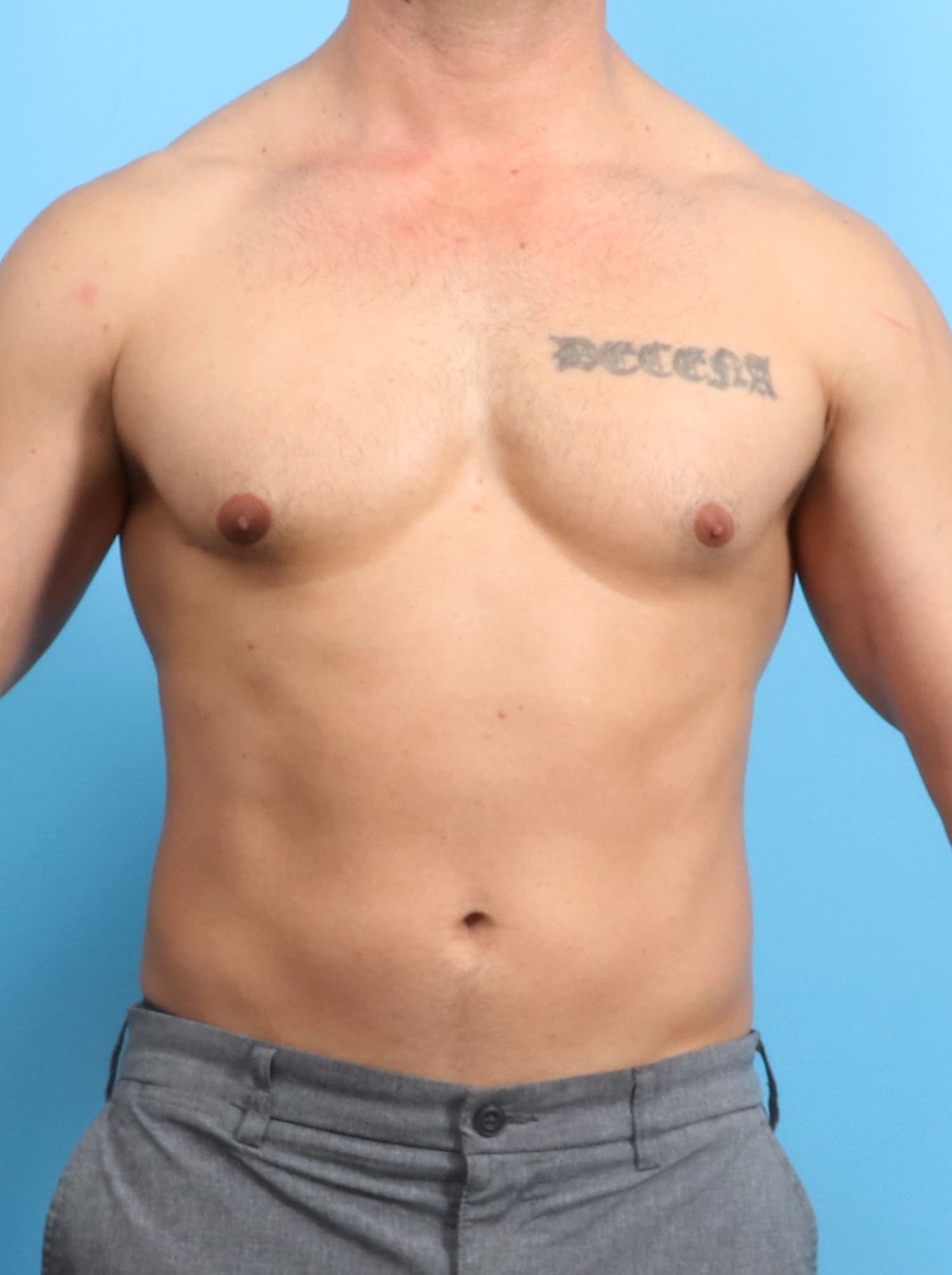 Male Breast Reduction case #1534 after, image 1