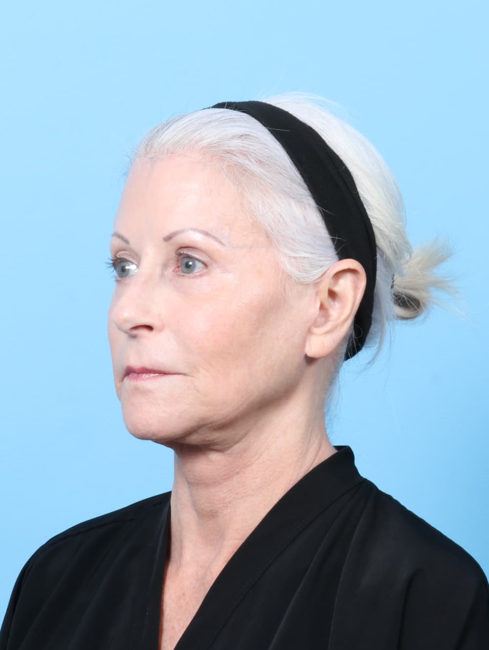 Facelift case #7863 after, image 3