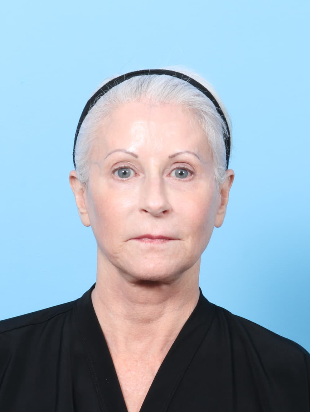 Facelift case #7863 after, image 1