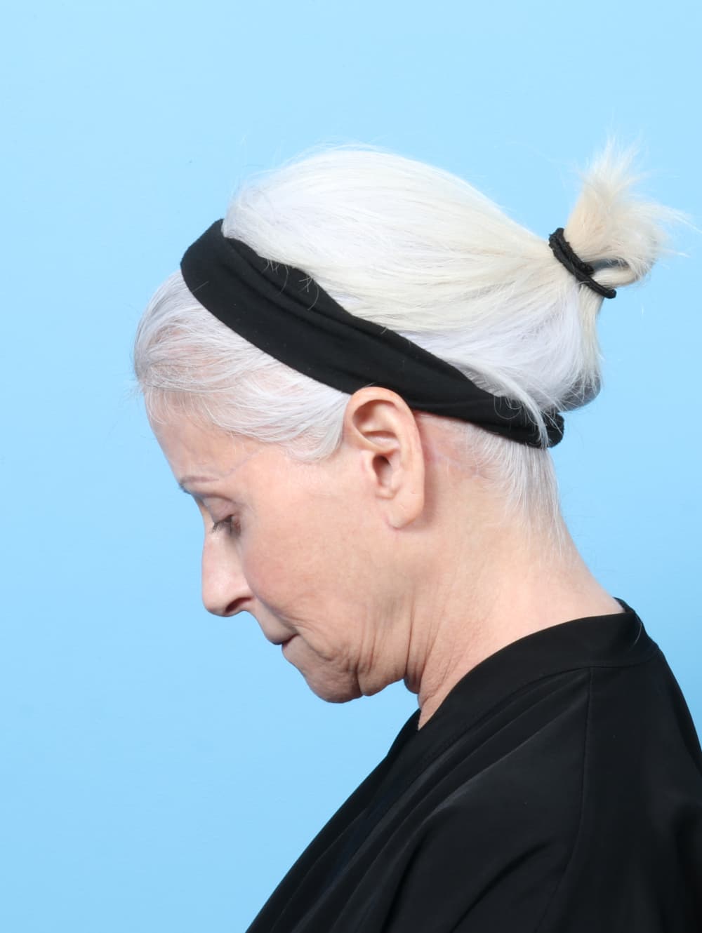 Facelift case #7863 after, image 2