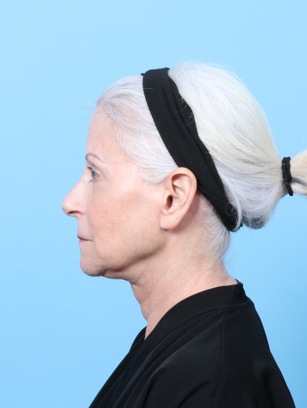 Facelift case #7863 after, image 4