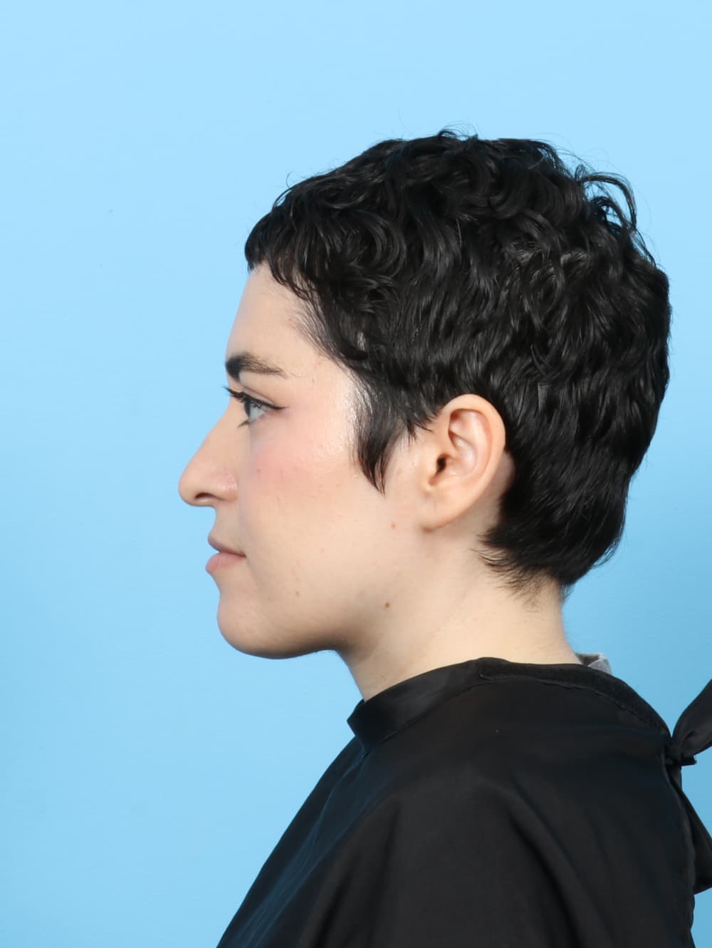 Facial Surgery case #7668 before