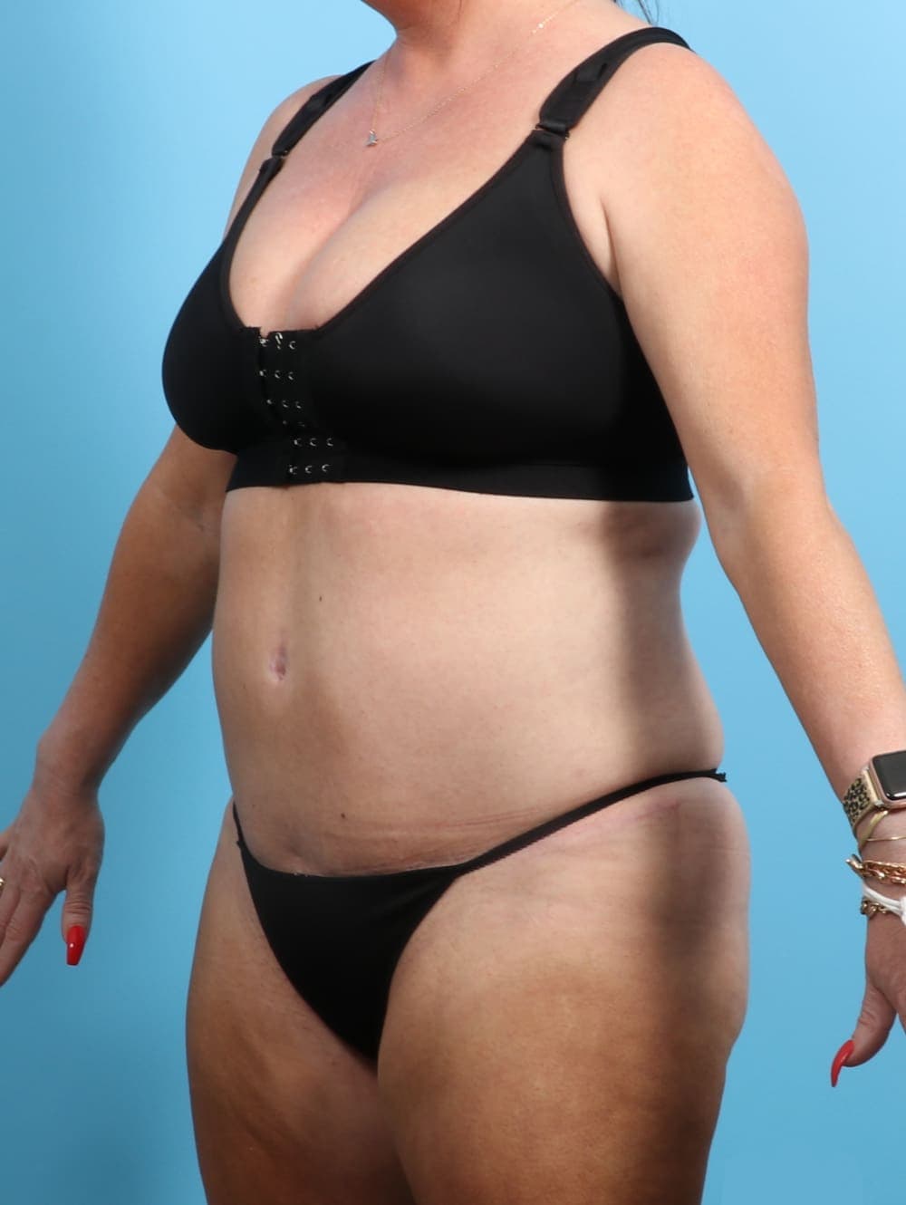 Tummy Tuck case #2330 after, image 2