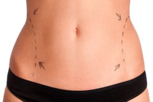 Closeup image of woman's midsection with markings before liposuction.
