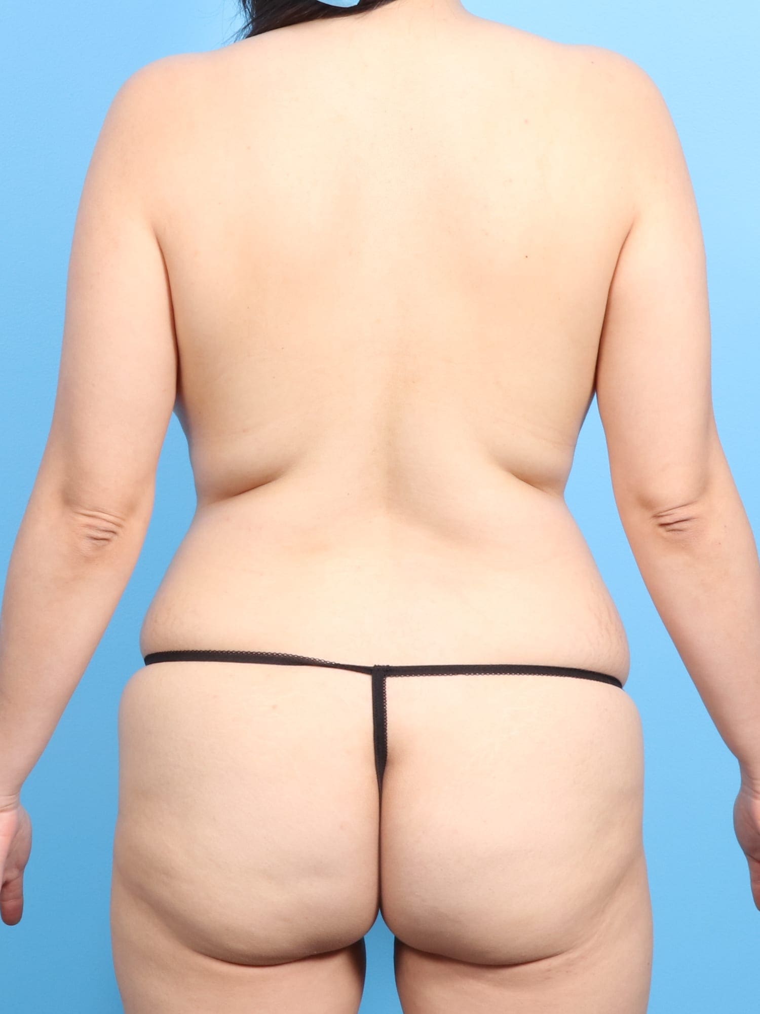 Breast Lift/Reduction Patient Photo - Case 1202 - before view-3