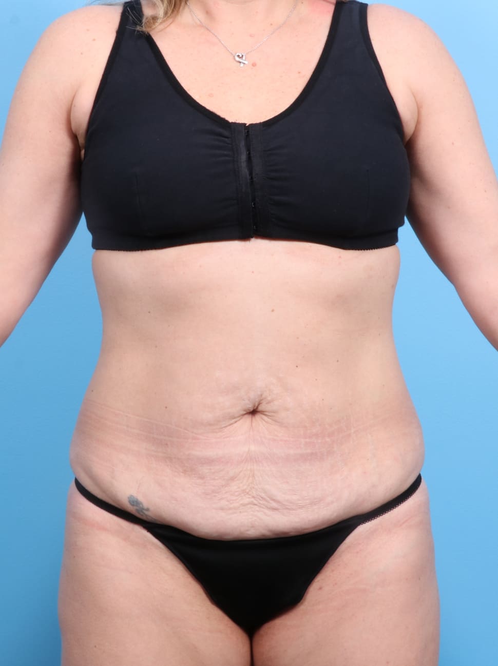 Tummy Tuck Patient Photo - Case 1240 - before view-
