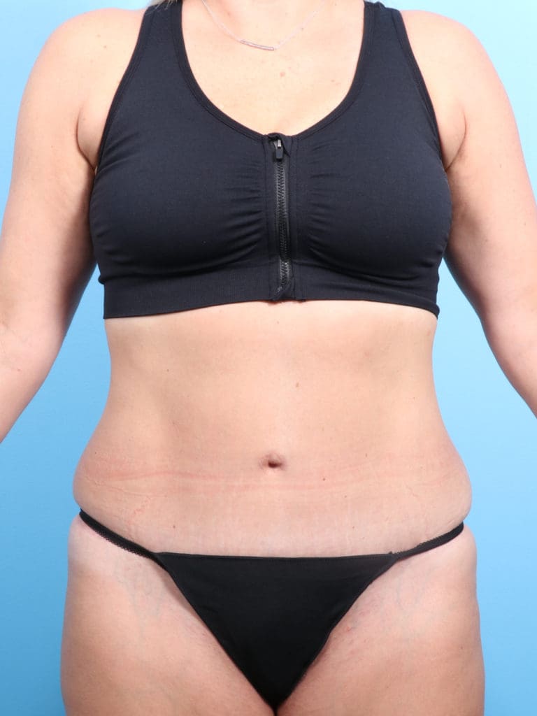 Tummy Tuck - Case 1240 - After