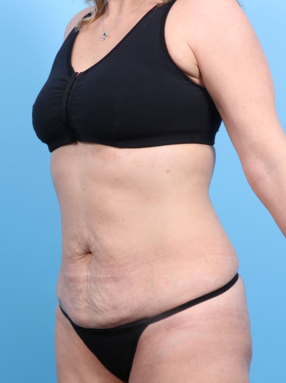 Tummy Tuck Patient Photo - Case 1240 - before view-1