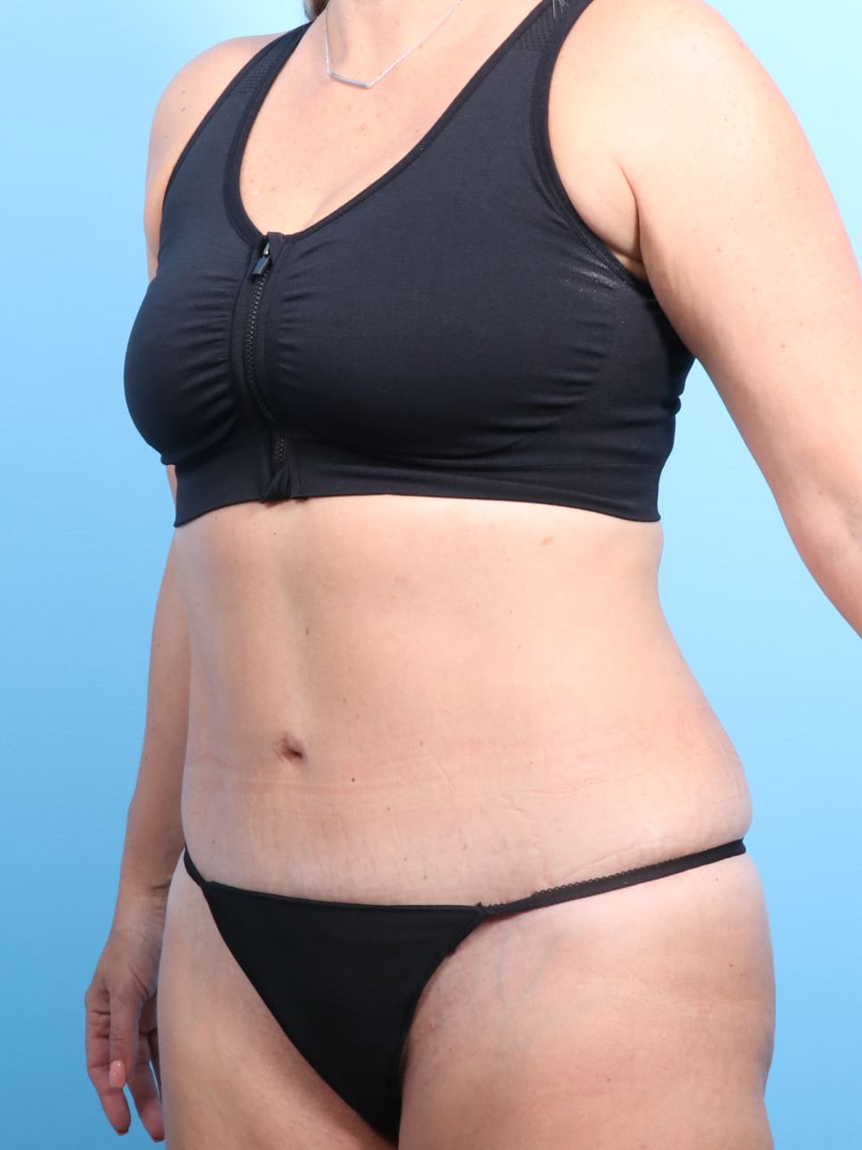 Tummy Tuck Patient Photo - Case 1240 - after view-1
