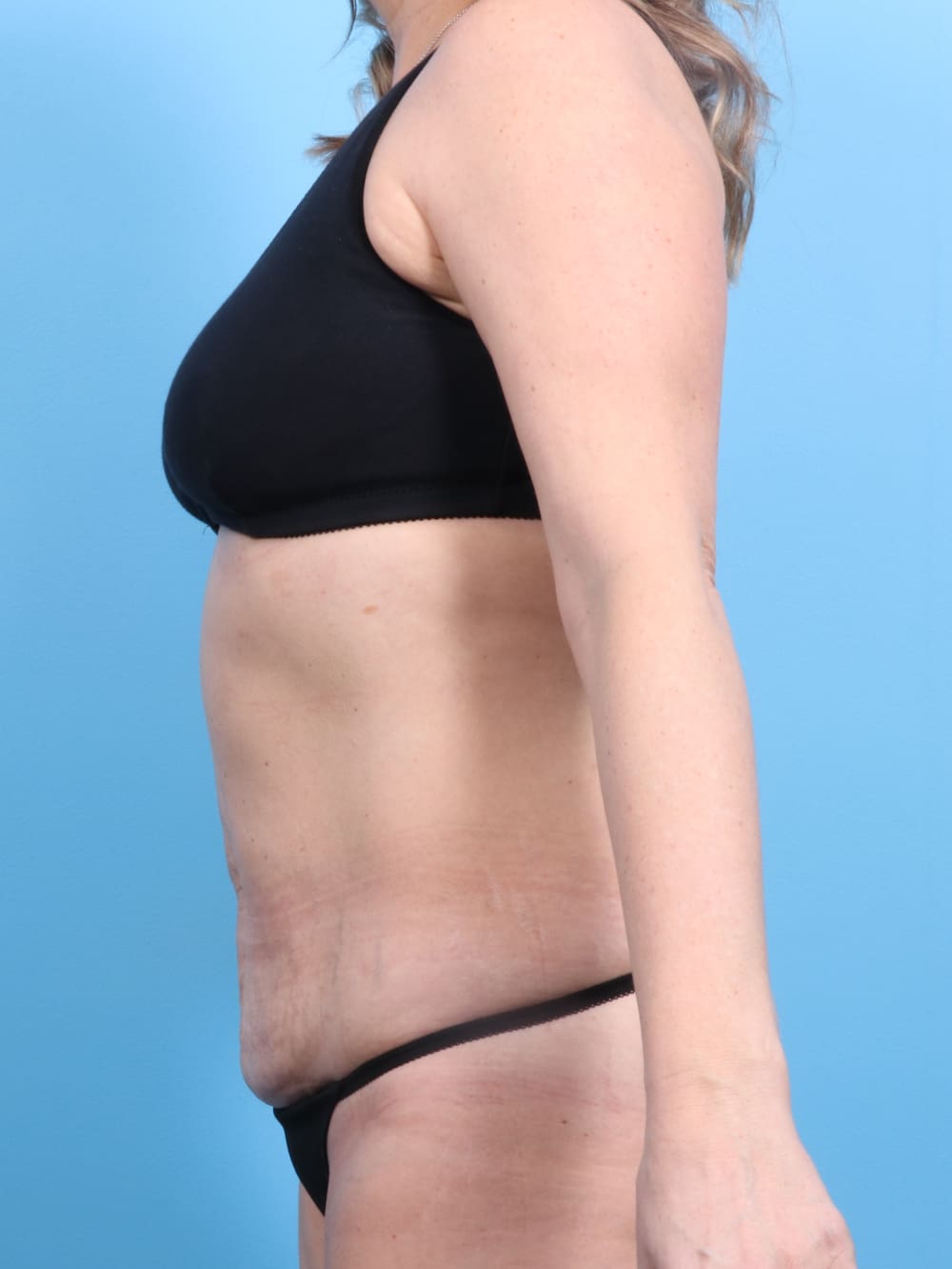 Tummy Tuck Patient Photo - Case 1240 - before view-2