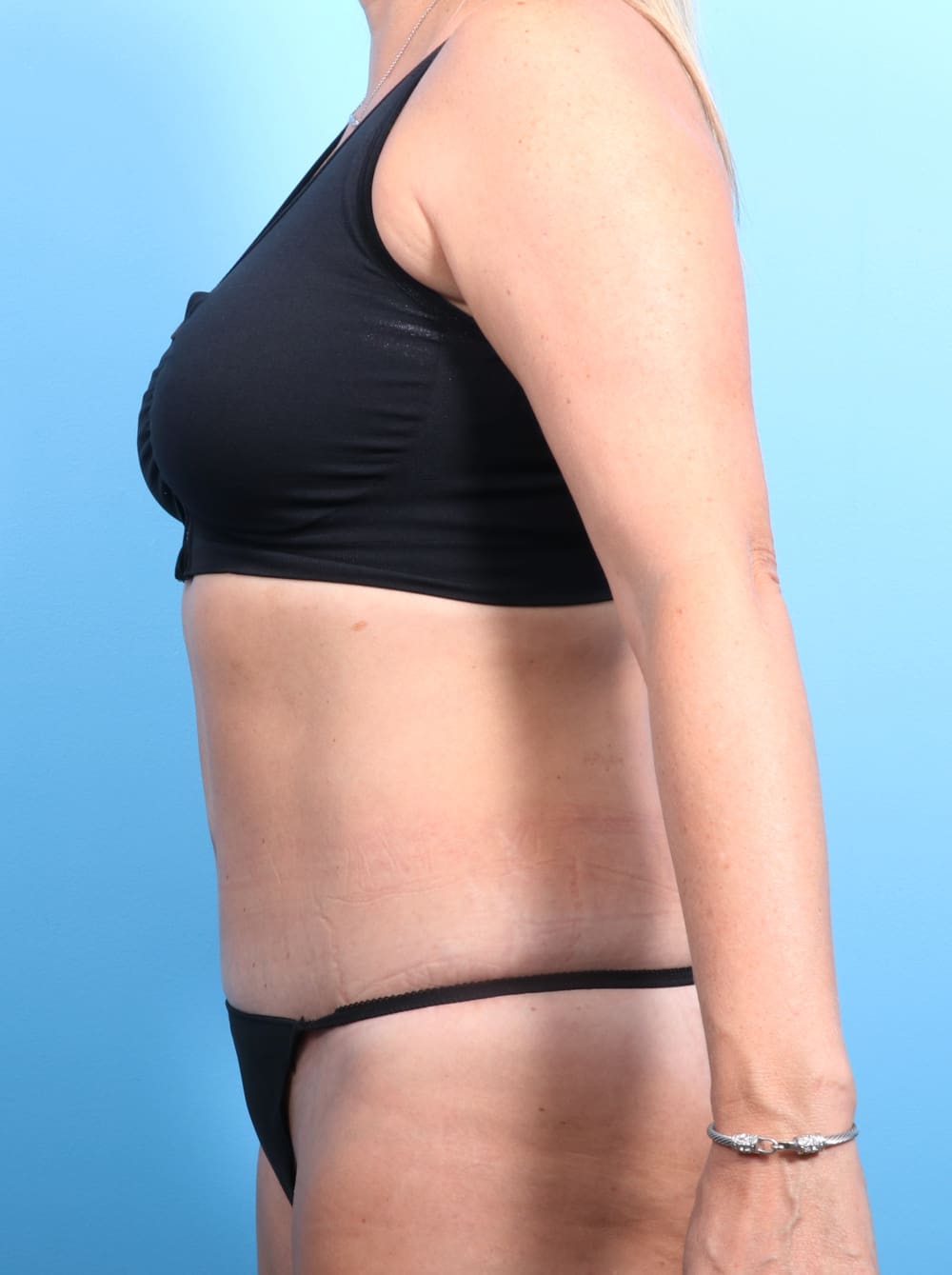 Tummy Tuck Patient Photo - Case 1240 - after view-2