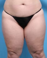 Liposuction - Case 1257 - Before