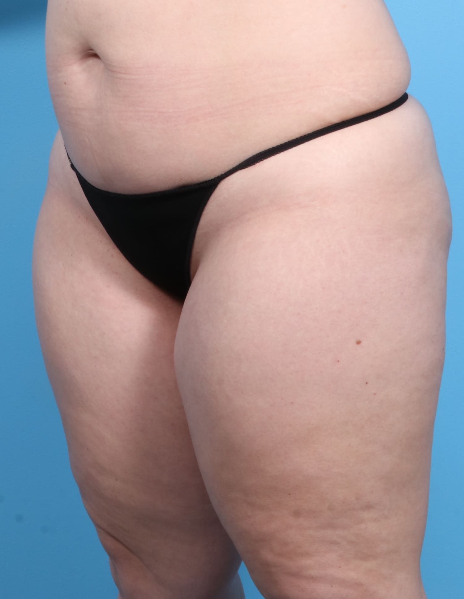 Liposuction Patient Photo - Case 1257 - before view-1
