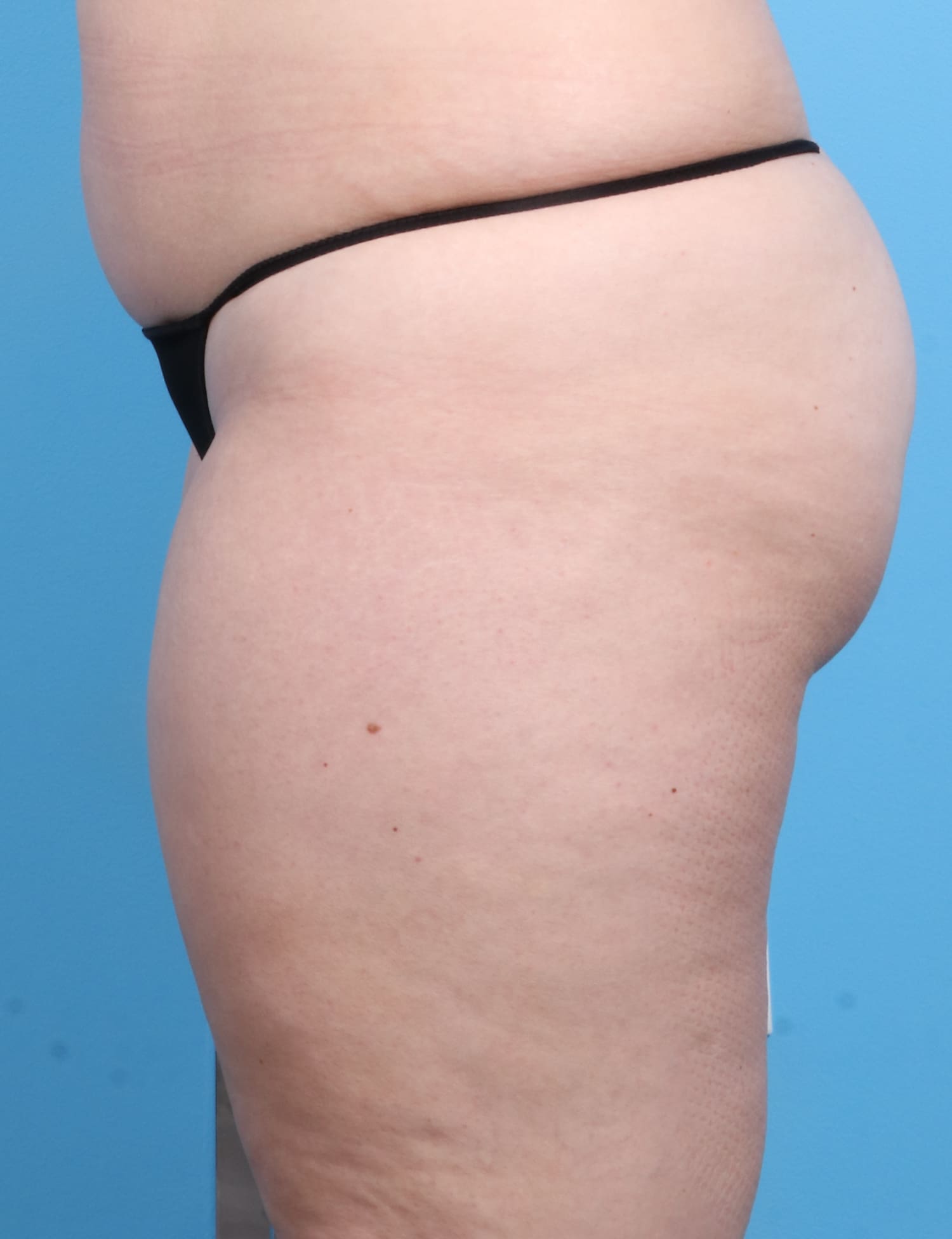Liposuction Patient Photo - Case 1257 - before view-2