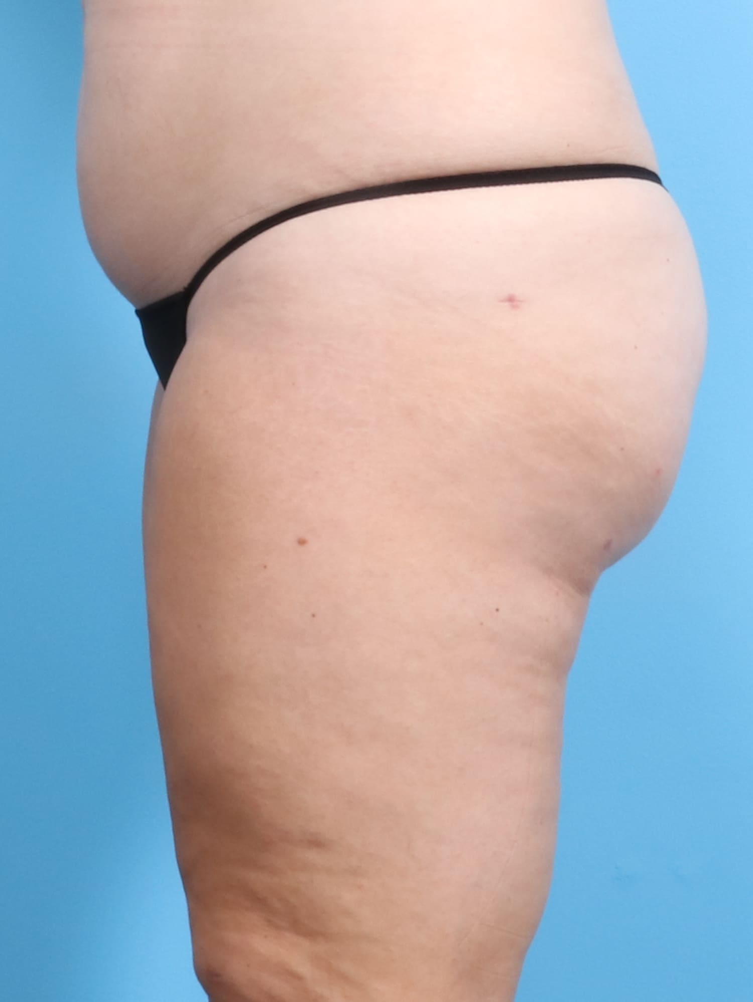 Liposuction Patient Photo - Case 1257 - after view-2