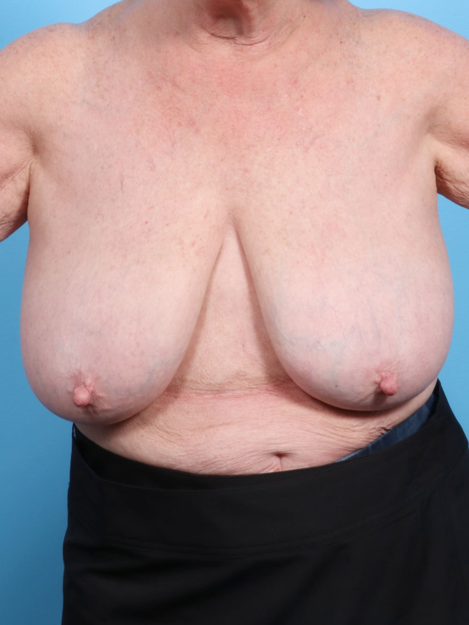 Breast Lift/Reduction Patient Photo - Case 1305 - before view-0
