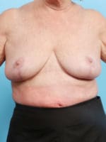 Breast Lift/Reduction - Case 1305 - After