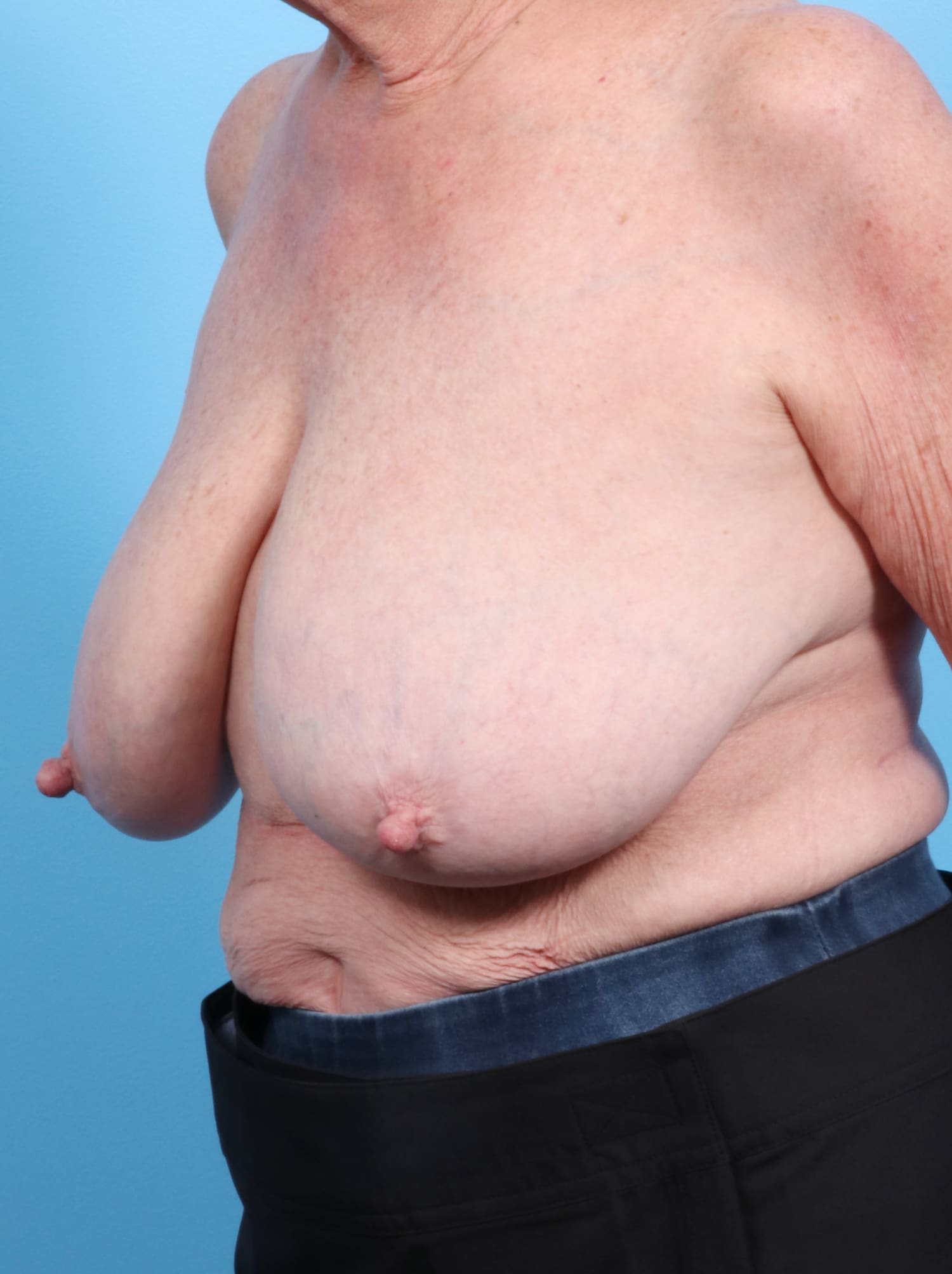 Breast Lift/Reduction Patient Photo - Case 1305 - before view-1