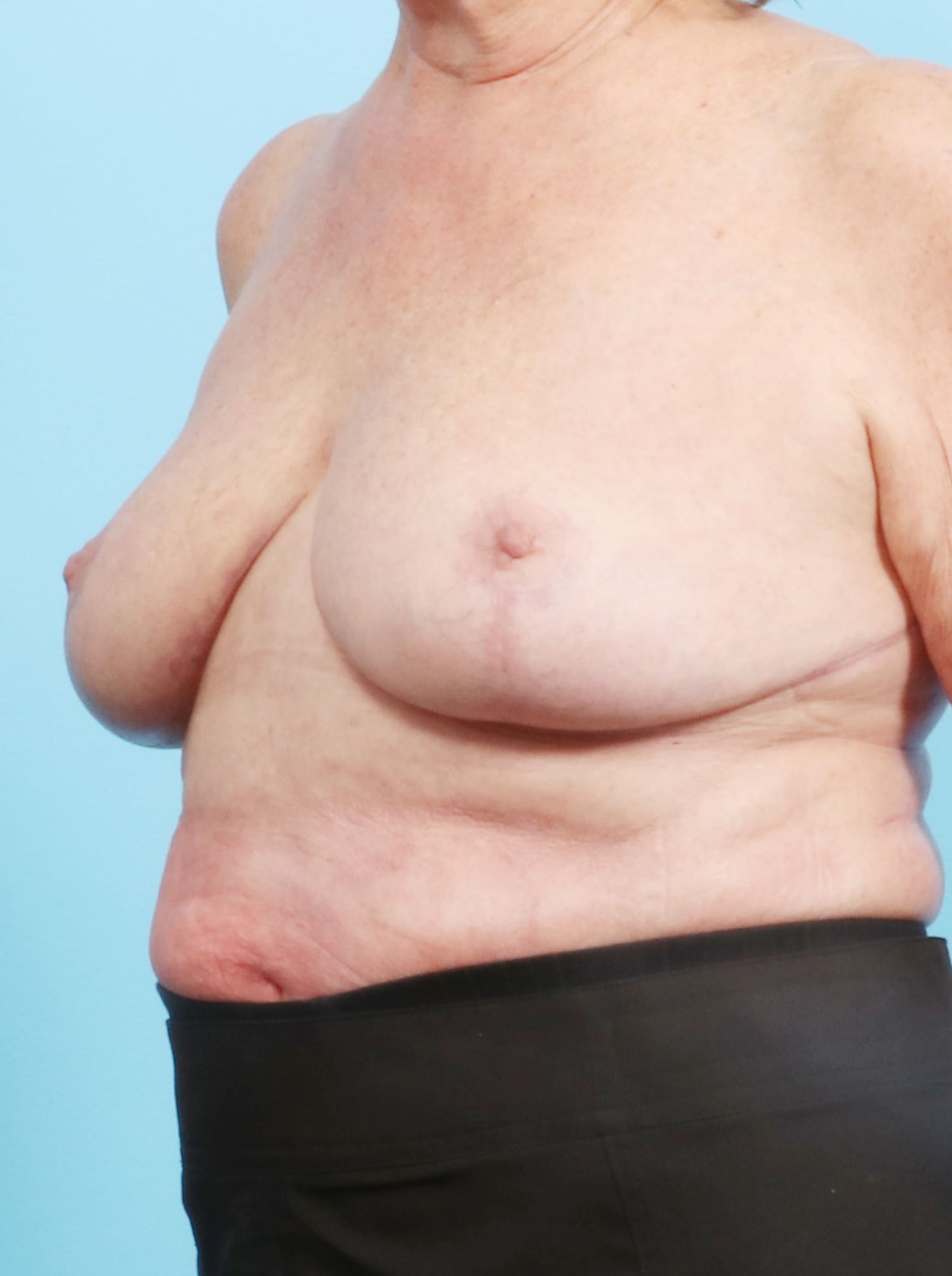 Breast Lift/Reduction Patient Photo - Case 1305 - after view-1