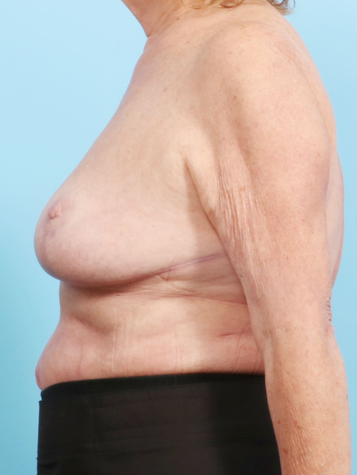 Breast Lift/Reduction Patient Photo - Case 1305 - after view-2