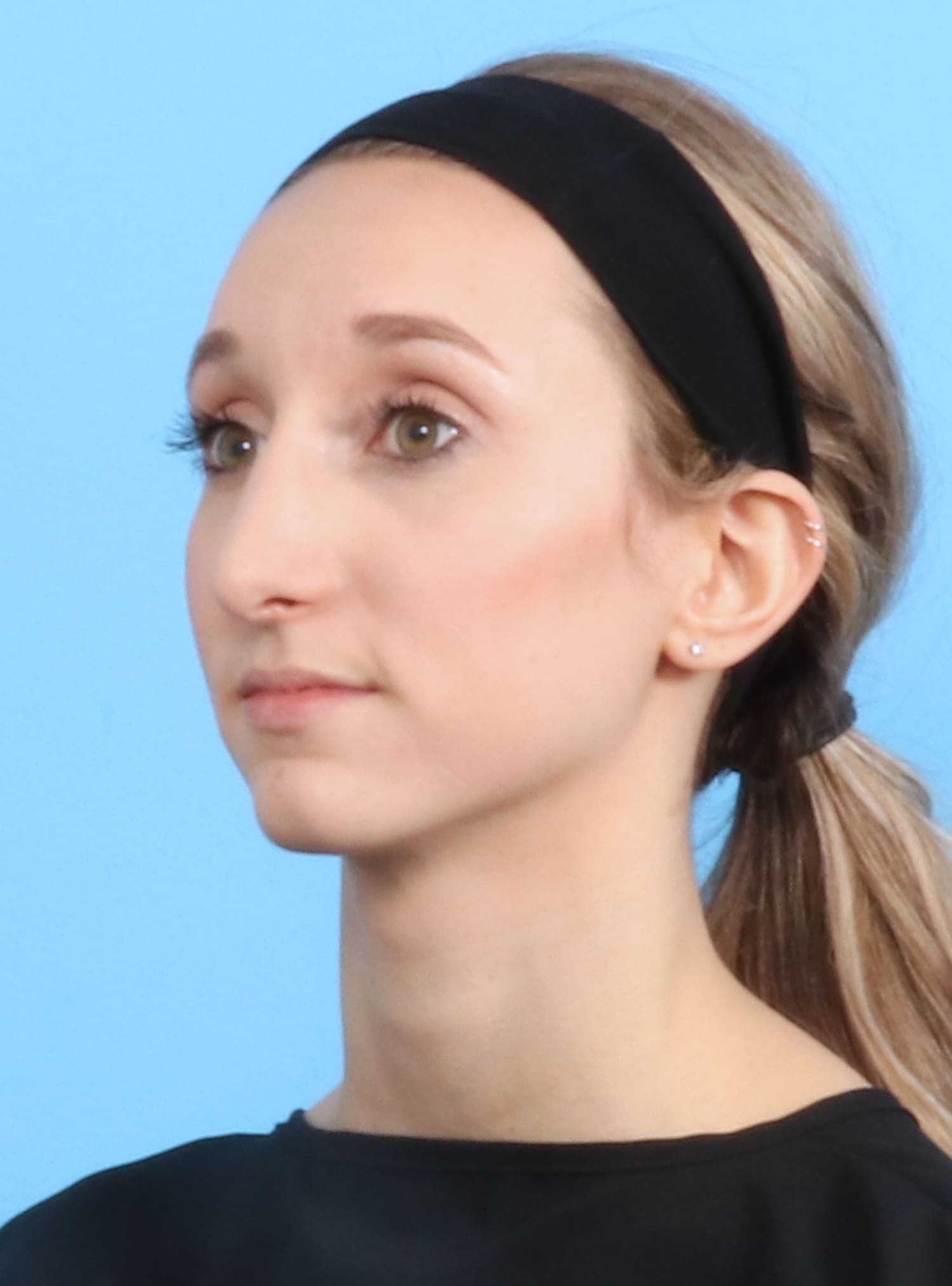 Rhinoplasty Patient Photo - Case 1321 - after view-2
