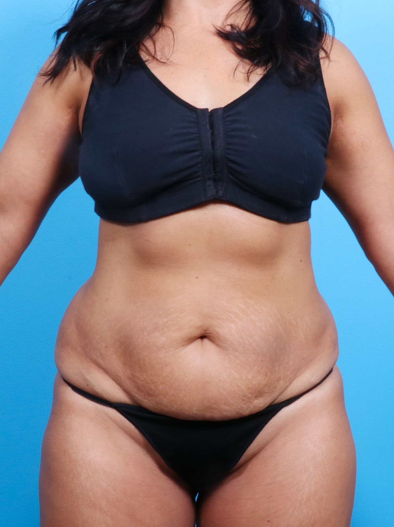 Tummy Tuck Patient Photo - Case 1526 - before view-