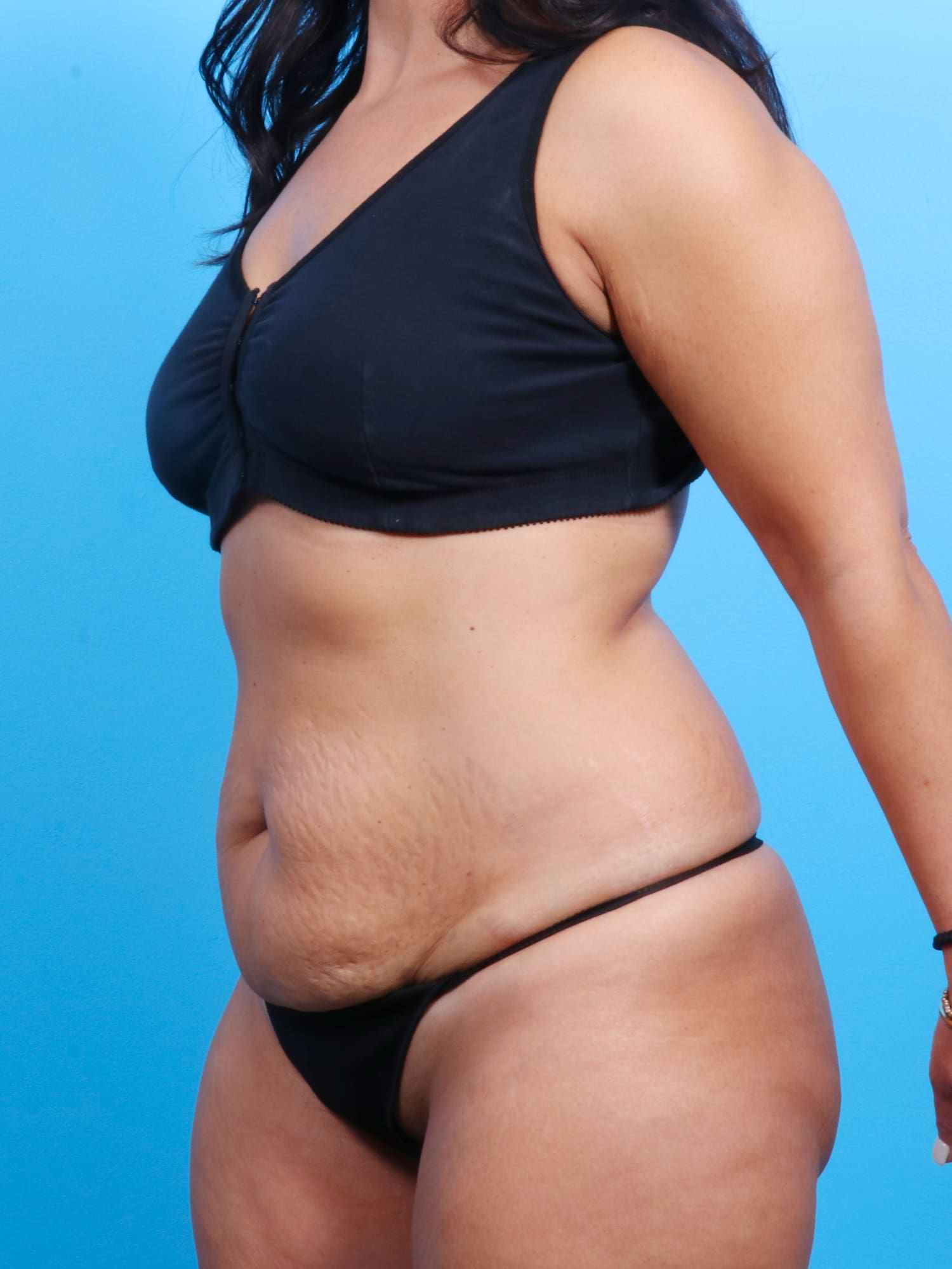 Tummy Tuck Patient Photo - Case 1526 - before view-1