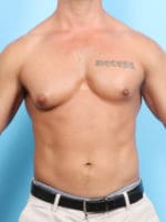 Male Breast Reduction - Case 1534 - Before