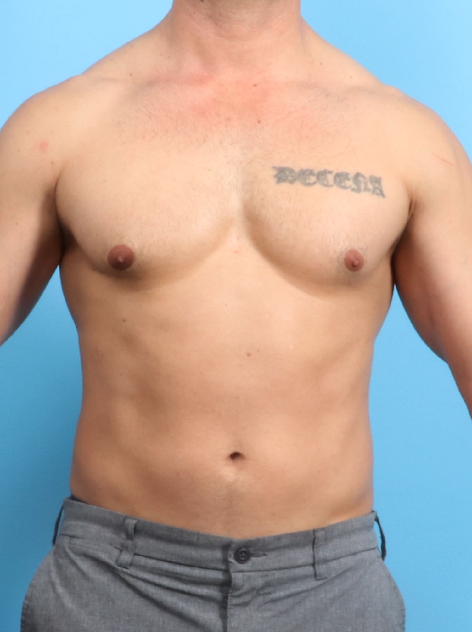 Male Breast Reduction Patient Photo - Case 1534 - after view