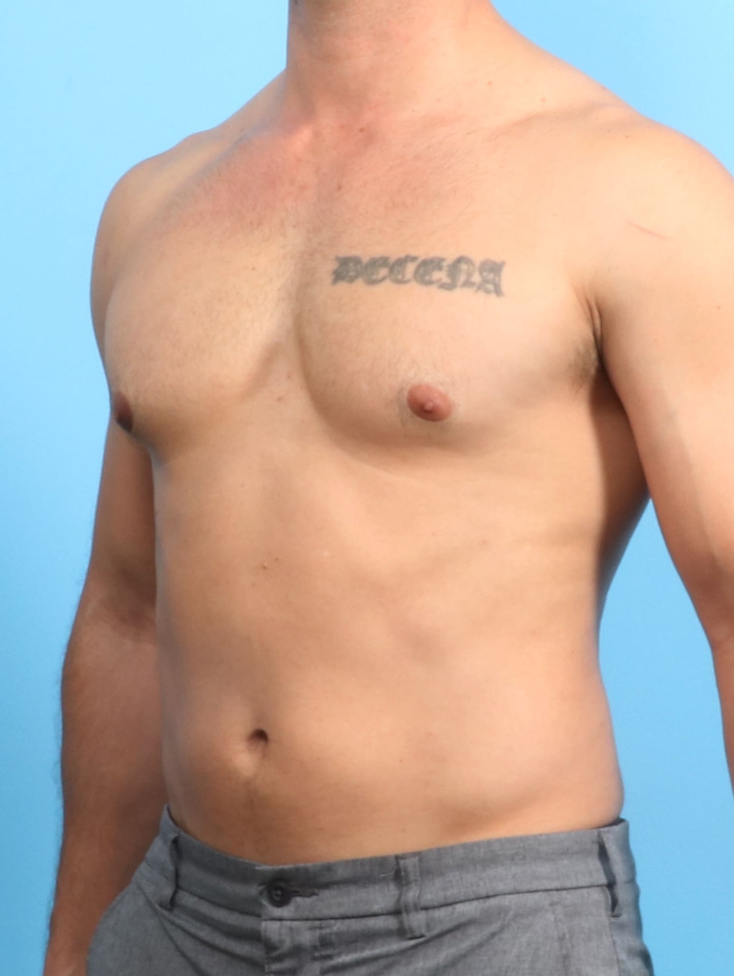 Male Breast Reduction Patient Photo - Case 1534 - after view-1