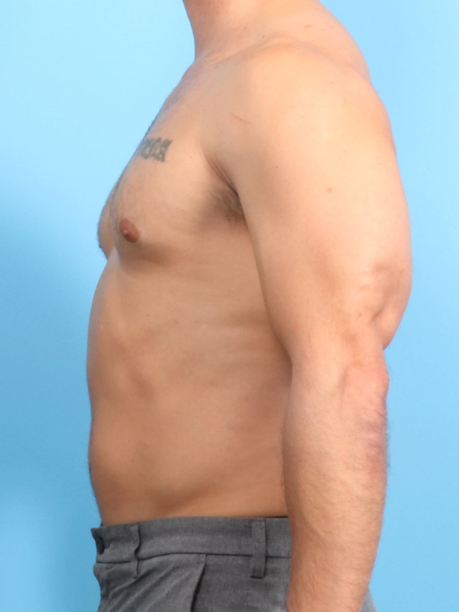 Male Breast Reduction Patient Photo - Case 1534 - after view-2
