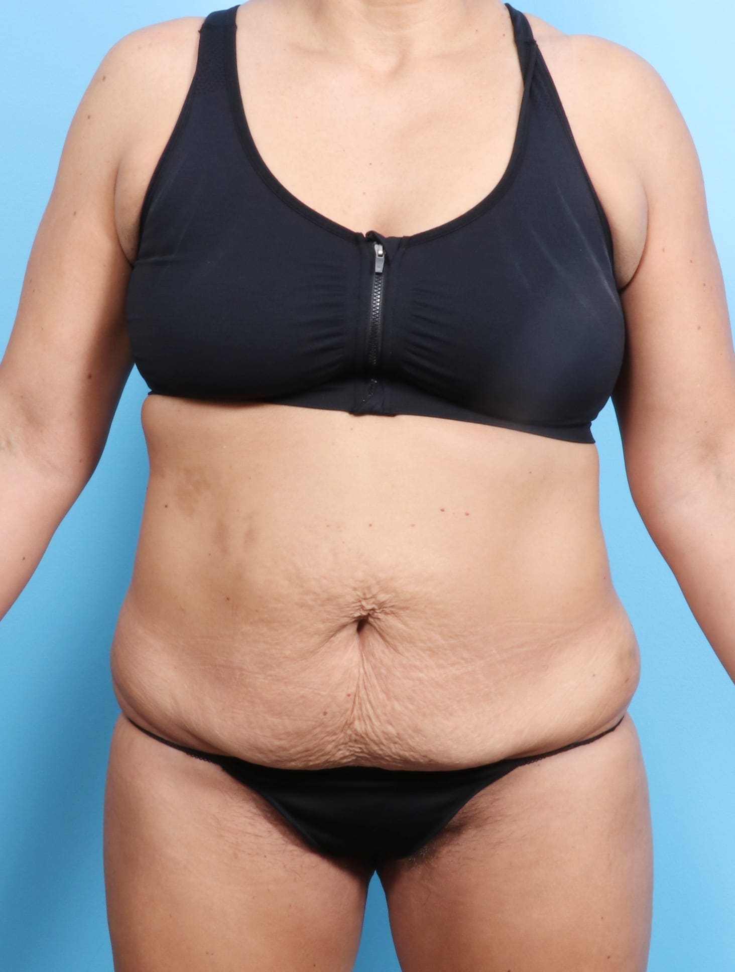 Tummy Tuck Patient Photo - Case 1675 - before view-0