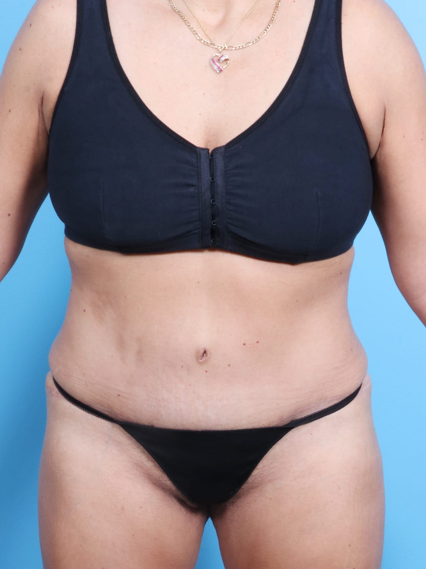 Tummy Tuck Patient Photo - Case 1675 - after view