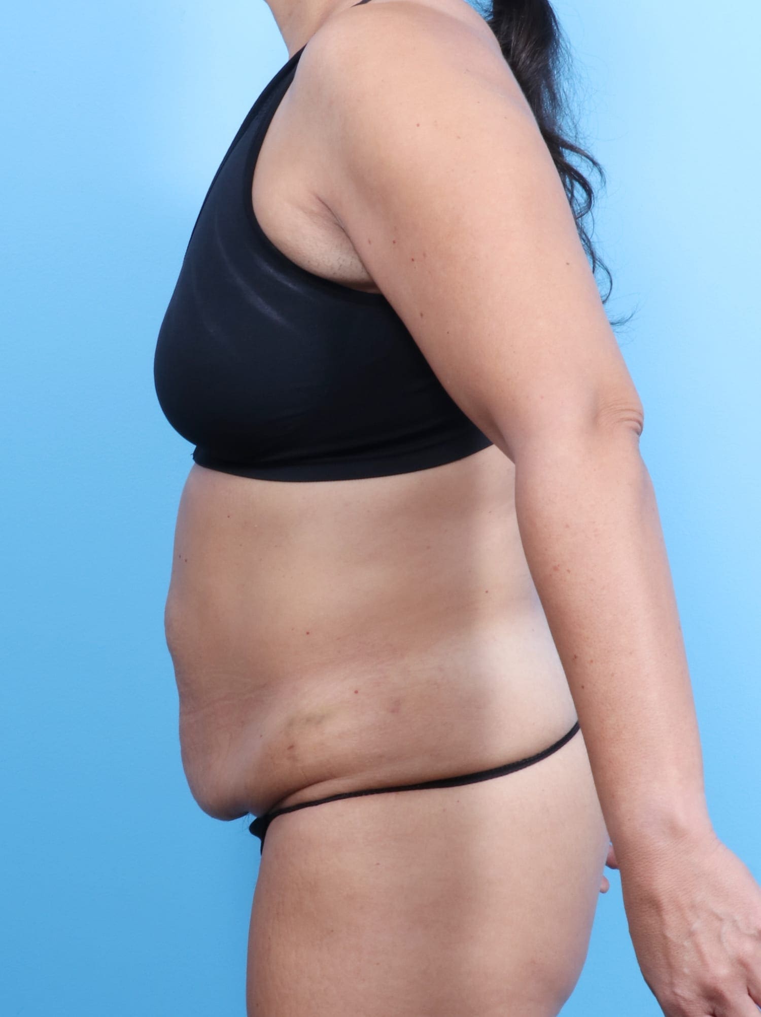 Tummy Tuck Patient Photo - Case 1675 - before view-2
